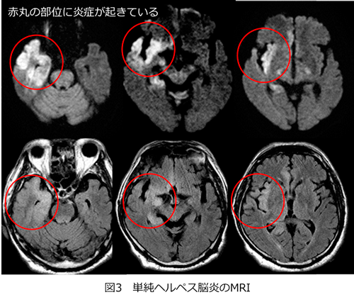 図3 単純ヘルペス脳炎のMRI
